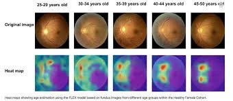 Εικονογράφηση από τη μελέτη που δείχνει διαφορετικούς χάρτες θερμότητας του ματιού για διαφορετικές ηλικιακές ομάδες