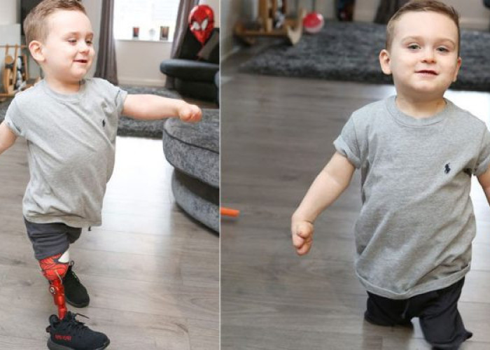 3ΧΡΟΝΟΣ ΠΟΥ ΕΧΑΣΕ ΤΑ ΠΟΔΙΑ ΤΟΥ ΑΠΟ ΜΗΝΙΓΓΙΤΙΔΑ ΕΚΑΝΕ ΤΑ ΠΡΩΤΑ ΤΟΥ ΒΗΜΑΤΑ ΜΕ ΠΡΟΣΘΕΤΙΚΑ ΑΚΡΑ ΚΑΙ ΣΥΓΚΙΝΕΙ!