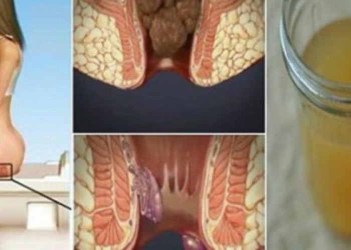 ΘΕΡΑΠΕΙΑ ΤΩΝ ΑΙΜΟΡΡΟΙΔΩΝ ΣΤΟ ΣΠΙΤΙ ΜΕ ΕΝΑ ΜΟΝΟ ΣΥΣΤΑΤΙΚΟ!