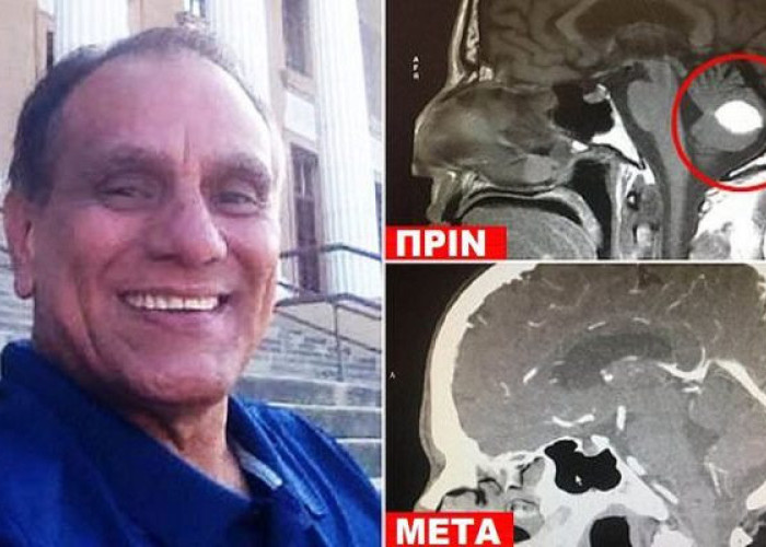 ANΤΡΑΣ ΜΕ ΚΑΡΚΙΝΟ «ΚΕΡΔΙΣΕ» ΤΟΝ ΟΓΚΟ ΣΤΟ ΚΕΦΑΛΙ ΜΕ ΠΡΟΣΕΥΧΗ ΣΤΟ ΘΕΟ ΚΑΙ ΟΙ ΓΙΑΤΡΟΙ «ΣΚΙΖΟΥΝ ΤΑ ΠΤΥΧΙΑ ΤΟΥΣ»