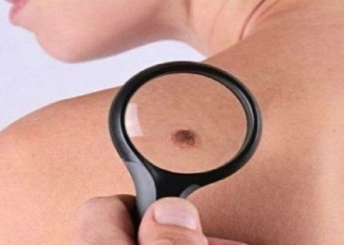 ΣΑΣ «ΤΡΩΝΕ» ΟΙ ΕΛΙΕΣ ΣΤΟ ΔΕΡΜΑ ΣΑΣ; ΔΕΙΤΕ ΠΟΤΕ Η ΦΑΓΟΥΡΑ ΕΙΝΑΙ ΚΑΡΚΙΝΟΣ!