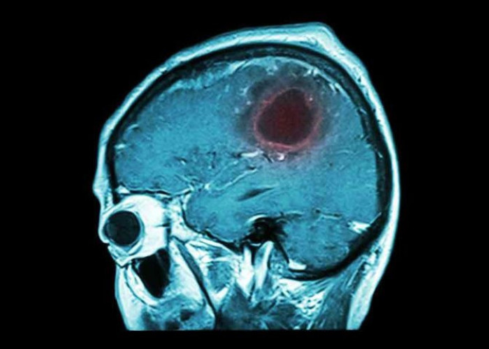 ΟΓΚΟΣ ΣΤΟΝ ΕΓΚΕΦΑΛΟ: ΤΑ 7 ΠΡΟΕΙΔΟΠΟΙΗΤΙΚΑ ΣΗΜΑΔΙΑ ΠΟΥ ΠΡΕΠΕΙ ΝΑ ΓΝΩΡΙΖΕΤΕ!