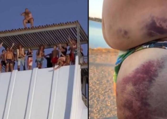 Κι όμως πλήρωσε το άλμα «θανάτου» από τη νεροτσουλήθρα – Το κορμί του έγινε μωβ από τις μελανιές