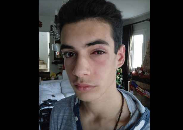 Ξυλοδαρμός 15χρονου στη Χαλκιδική – Η ανάρτηση της μητέρας του