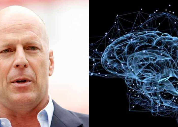 Τι είναι η μετωποκροταφική άνοια με την οποία διαγνώστηκε ο Μπρους Γουίλις