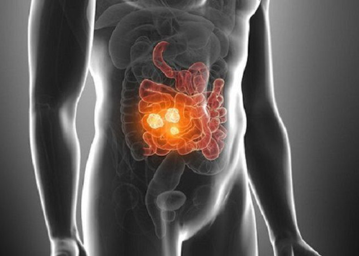 Καρκίνος εντέρου: Αυτή είναι η τροφή που σκοτώνει το 75% των όγκων σύμφωνα με νέα έρευνα