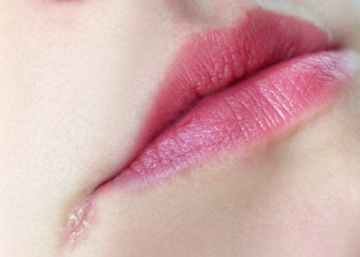 Τι να κάνετε για να μην σκάσουν τα χείλη σας από το τσουχτερό κρύο