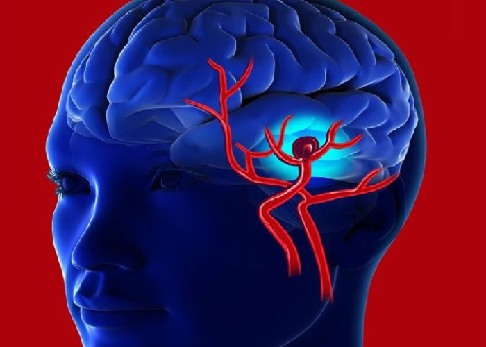 Ανεύρυσμα εγκεφάλου: Μην αγνοήσετε τα αθώα πρώιμα συμπτώματα