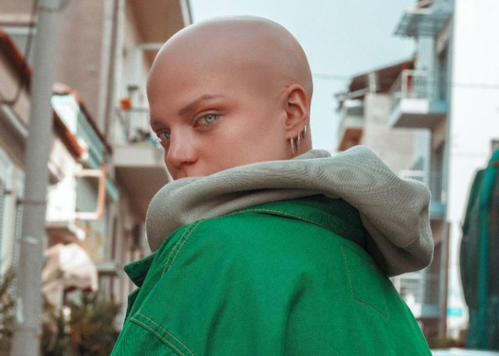 Είμαι η Δωροθέα και έχω αλωπεκία