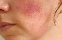 ΛΥΚΟΣ: 5 ΒΑΣΙΚΑ ΣΥΜΠΤΩΜΑΤΑ ΤΗΣ ΑΥΤΟΑΝΟΣΗΣ ΠΑΘΗΣΗΣ!