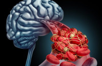 ΑΝΕΥΡΙΣΜΑ ΕΓΚΕΦΑΛΟΥ: TI EINAI; ΜΗΝ ΑΓΝΟΗΣΕΤΕ ΤΑ «ΑΘΩΑ»ΠΡΩΙΜΑ ΣΥΜΠΤΩΜΑΤΑ!