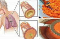 ΑΡΧΑΙΟ ΣΠΙΤΙΚΟ ΣΙΡΟΠΙ ΠΟΥ ΑΦΑΙΡΕΙ ΤΟ ΦΛΕΓΜΑ ΑΠΟ ΤΟΥΣ ΠΝΕΥΜΟΝΕΣ ΚΑΙ ΘΕΡΑΠΕΥΕΙ ΤΟΝ ΒΗΧΑ!