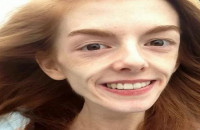 ΕΚΠΛΗΚΤΙΚΗ ΜΕΤΑΜΟΡΦΩΣΗ: ΑΝΟΡΕΞΙΚΗ ΠΟΥ ΖΥΓΙΖΕ 30 ΚΙΛΑ ΣΩΘΗΚΕ ΑΠΟ ΤΗ ΣΟΚΟΛΑΤΑ!