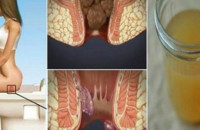 ΘΕΡΑΠΕΙΑ ΤΩΝ ΑΙΜΟΡΡΟΙΔΩΝ ΣΤΟ ΣΠΙΤΙ ΜΕ ΕΝΑ ΜΟΝΟ ΣΥΣΤΑΤΙΚΟ!