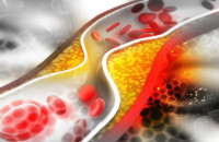 ΣΤΕΝΩΣΗ ΑΡΤΗΡΙΩΝ: TI NA TΡΩΤΕ ΚΑΙ ΤΙ ΝΑ ΑΠΟΦΥΓΕΤΕ!