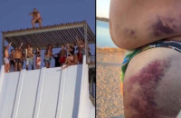 Κι όμως πλήρωσε το άλμα «θανάτου» από τη νεροτσουλήθρα – Το κορμί του έγινε μωβ από τις μελανιές