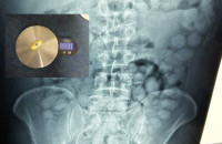 Συνελήφθη Βραζιλιάνος στο «Ελ. Βενιζέλος» για διακίνηση ναρκωτικών – Είχε καταπιεί 100 «αυγά» κοκαΐνης