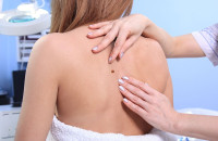 Καρκίνος του δέρματος: Τα 5 σημάδια στις ελιές που δεν πρέπει να αγνοήσετε – Πρόσεξέ το – σώζει ζωές