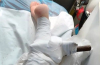 Σοκ στη Χαλκιδική: Ομπρέλα καρφώθηκε στο πόδι 26χρονης – Φυσούσαν θυελλώδεις άνεμοι