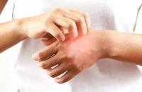 Τι είναι το αλλεργικό σοκ από το οποίο πέθανε ο 46χρονος στο Ναύπλιο: Πότε ένα τσίμπημα γίνεται απειλητικό για τη ζωή