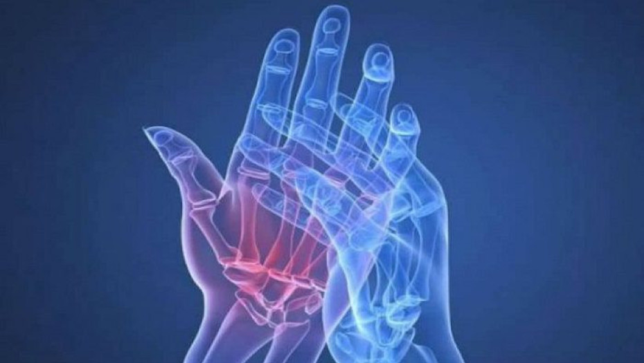 ΡΕΥΜΑΤΟΕIΔΗΣ ΑΡΘΡΙΤΙΔΑ. ΤΙ ΕΙΝΑΙ; ΠΟΙΑ ΕΙΝΑΙ ΤΑ ΣΥΜΠΤΩΜΑΤΑ ΚΑΙ ΠΟΙΑ Η ΚΑΤΑΛΛΗΛΗ ΔΙΑΤΡΟΦΗ;