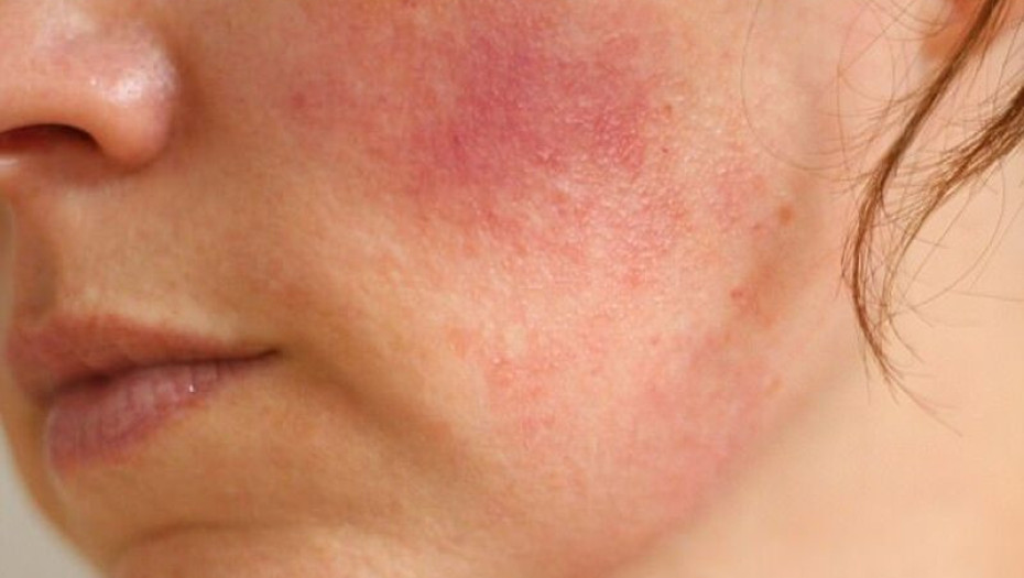 ΛΥΚΟΣ: 5 ΒΑΣΙΚΑ ΣΥΜΠΤΩΜΑΤΑ ΤΗΣ ΑΥΤΟΑΝΟΣΗΣ ΠΑΘΗΣΗΣ!