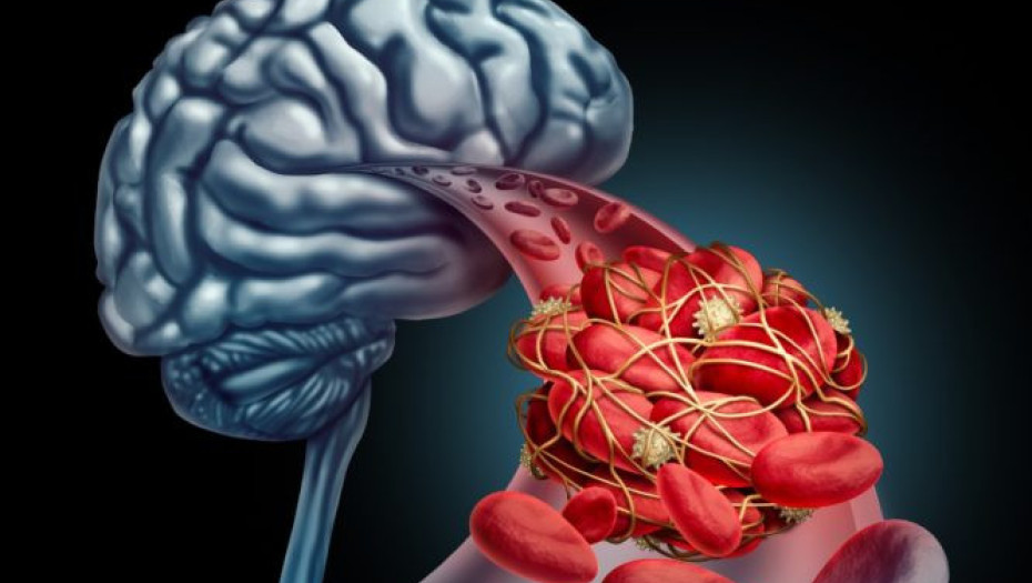 ΑΝΕΥΡΙΣΜΑ ΕΓΚΕΦΑΛΟΥ: TI EINAI; ΜΗΝ ΑΓΝΟΗΣΕΤΕ ΤΑ «ΑΘΩΑ»ΠΡΩΙΜΑ ΣΥΜΠΤΩΜΑΤΑ!