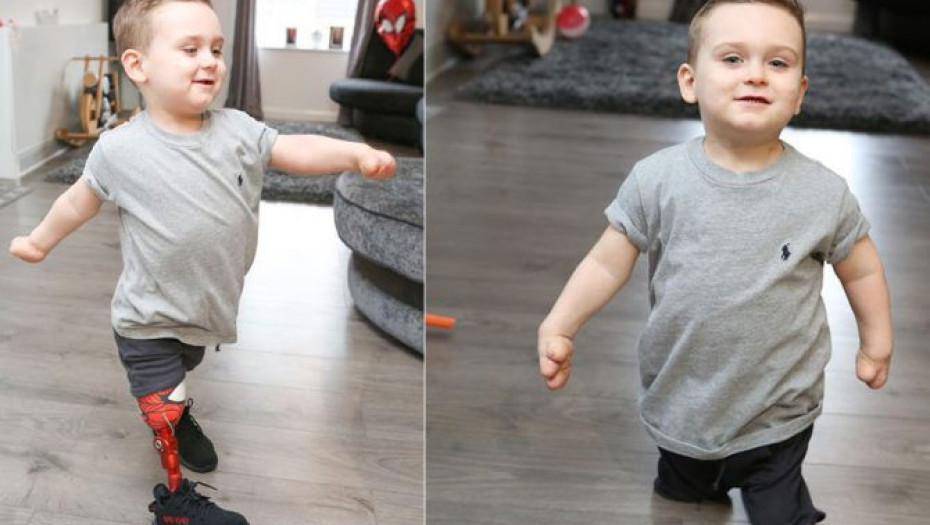 3ΧΡΟΝΟΣ ΠΟΥ ΕΧΑΣΕ ΤΑ ΠΟΔΙΑ ΤΟΥ ΑΠΟ ΜΗΝΙΓΓΙΤΙΔΑ ΕΚΑΝΕ ΤΑ ΠΡΩΤΑ ΤΟΥ ΒΗΜΑΤΑ ΜΕ ΠΡΟΣΘΕΤΙΚΑ ΑΚΡΑ ΚΑΙ ΣΥΓΚΙΝΕΙ!