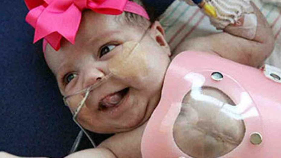 Το μωράκι που γεννήθηκε με την καρδιά έξω από το σώμα του τα κατάφερε και επιστρέφει στο σπίτι της!