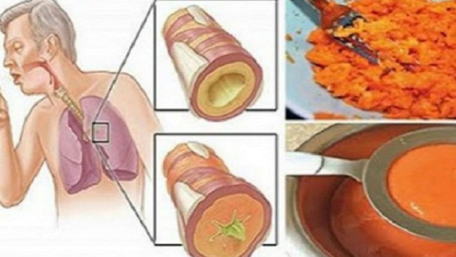 ΑΡΧΑΙΟ ΣΠΙΤΙΚΟ ΣΙΡΟΠΙ ΠΟΥ ΑΦΑΙΡΕΙ ΤΟ ΦΛΕΓΜΑ ΑΠΟ ΤΟΥΣ ΠΝΕΥΜΟΝΕΣ ΚΑΙ ΘΕΡΑΠΕΥΕΙ ΤΟΝ ΒΗΧΑ!