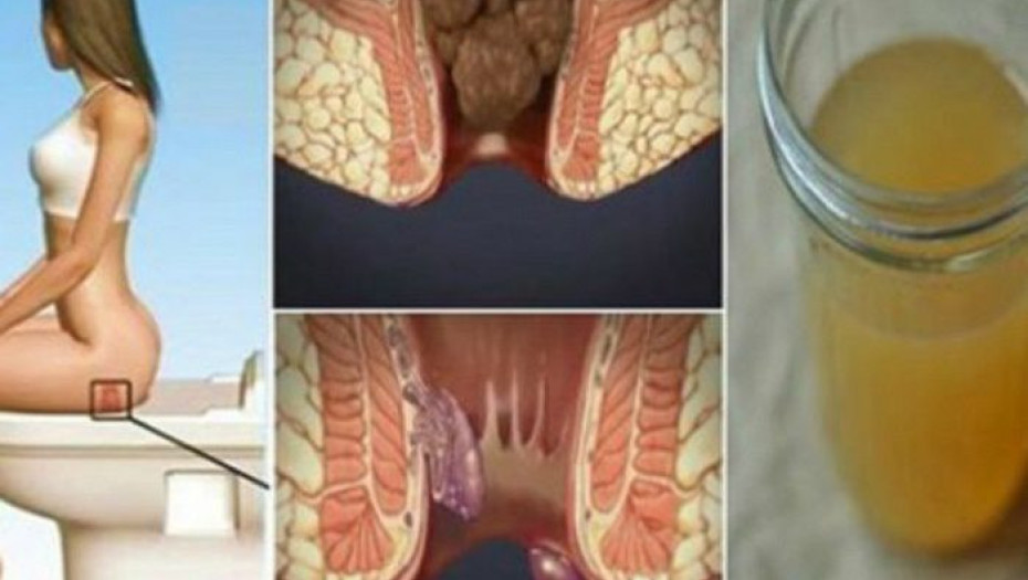 ΘΕΡΑΠΕΙΑ ΤΩΝ ΑΙΜΟΡΡΟΙΔΩΝ ΣΤΟ ΣΠΙΤΙ ΜΕ ΕΝΑ ΜΟΝΟ ΣΥΣΤΑΤΙΚΟ!