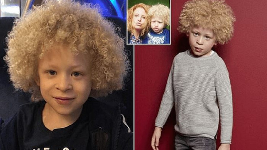 Αγοράκι 5 χρονών με αλμπινισμό έγινε μοντέλο σε γνωστή εταιρεία ρούχων χάρη σε μια φωτογραφία που ανέβασε η μαμά του στο Facebook