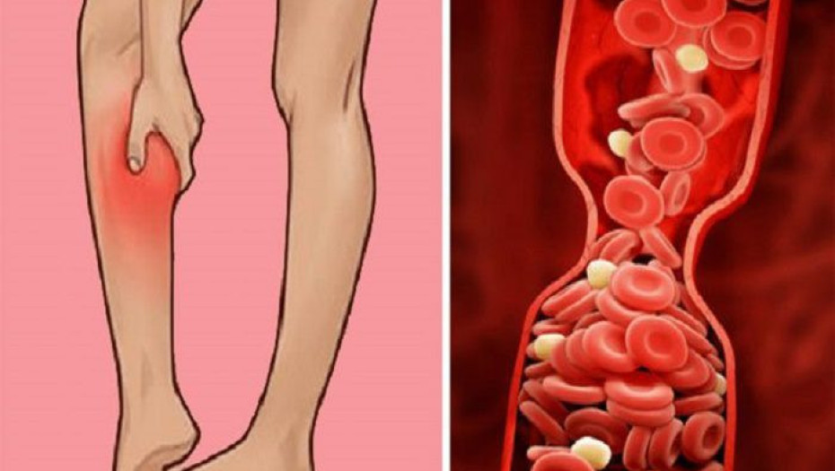 ΟΤΙ ΠΡΕΠΕΙ ΝΑ ΞΕΡΕΤΕ ΓΙΑ ΤΙΣ ΘΡΟΜΒΩΣΕΙΣ ΚΑΙ ΠΩΣ ΝΑ ΤΙΣ ΑΝΤΙΜΕΤΩΠΙΣΕΤΕ!