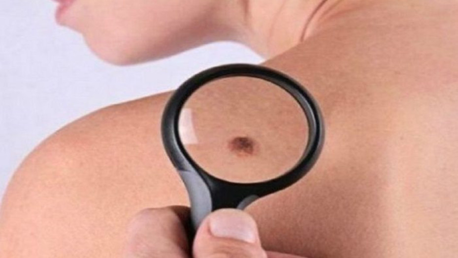 ΣΑΣ «ΤΡΩΝΕ» ΟΙ ΕΛΙΕΣ ΣΤΟ ΔΕΡΜΑ ΣΑΣ; ΔΕΙΤΕ ΠΟΤΕ Η ΦΑΓΟΥΡΑ ΕΙΝΑΙ ΚΑΡΚΙΝΟΣ!