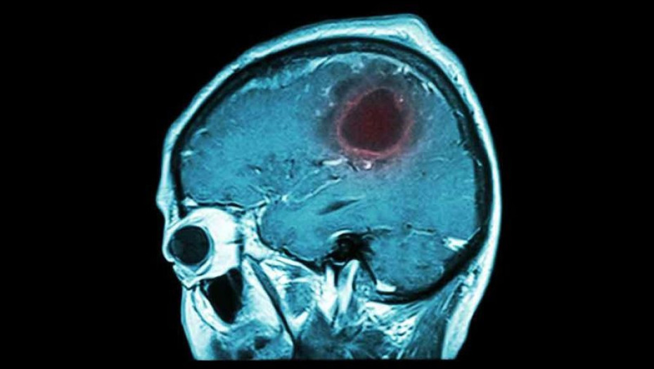 ΟΓΚΟΣ ΣΤΟΝ ΕΓΚΕΦΑΛΟ: ΤΑ 7 ΠΡΟΕΙΔΟΠΟΙΗΤΙΚΑ ΣΗΜΑΔΙΑ ΠΟΥ ΠΡΕΠΕΙ ΝΑ ΓΝΩΡΙΖΕΤΕ!
