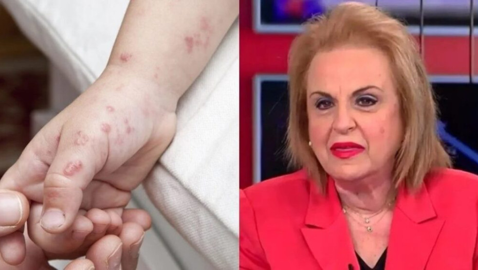 «Ο ιός θα εξαπλωθεί καλοκαίρι»: Σuvαγεpμός για την Ευλογιά των πιθήκων – Τι προκαλεί και πώς κολλάει