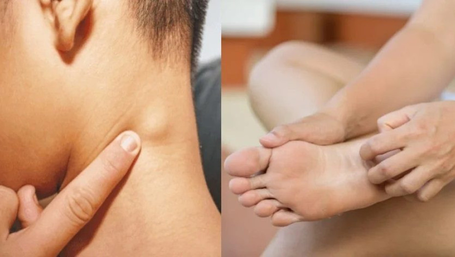 Λέμφωμα: Τα πρώιμα και αθώα συμπτώματα στο σώμα που σπάνια εντοπίζονται εγκαίρως