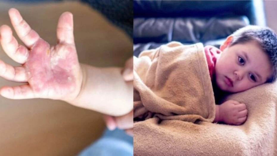 Γρίπη της ντομάτας: “Συναγερμός” για τον νέο μεταδοτικό ιό που απειλεί τα παιδιά – Τα ύπουλα συμπτώματα