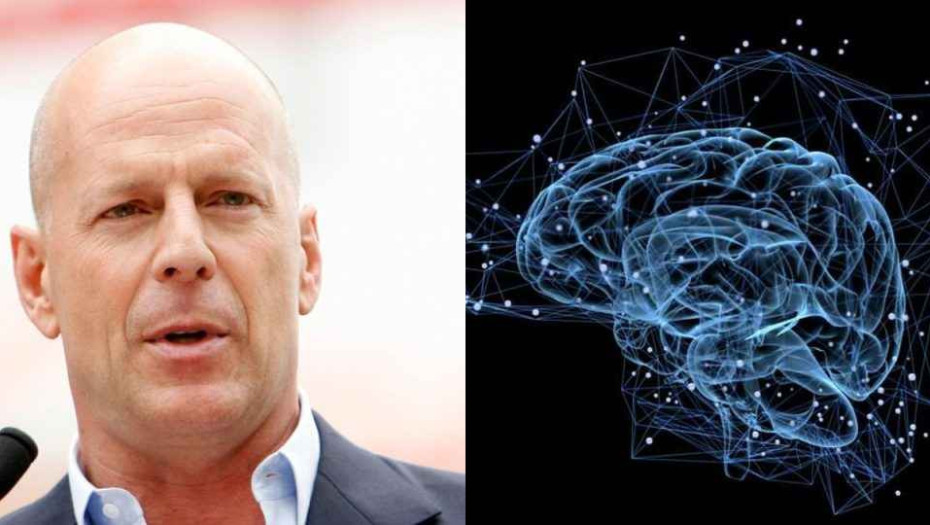 Τι είναι η μετωποκροταφική άνοια με την οποία διαγνώστηκε ο Μπρους Γουίλις