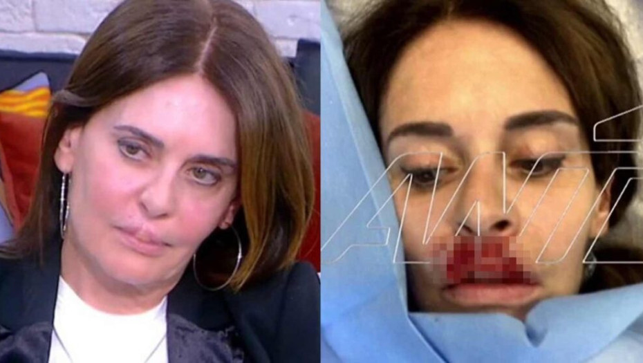 «Δεν μπορώ να πιώ χωρίς καλαμάκι»: Έλληνας πλαστικός κατέστρεψε τα χείλη της συγγραφέα, Κατερίνας Πλουμιδάκη