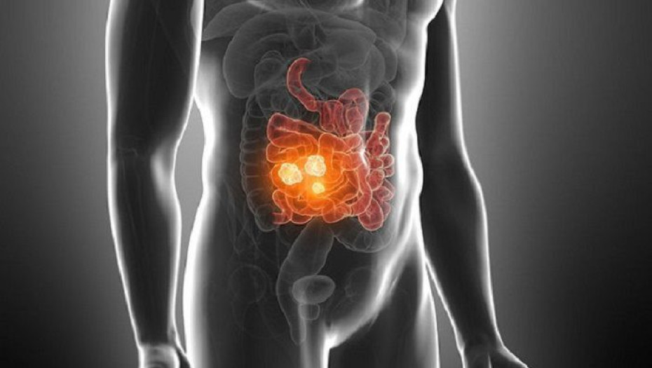 Καρκίνος εντέρου: Αυτή είναι η τροφή που σκοτώνει το 75% των όγκων σύμφωνα με νέα έρευνα