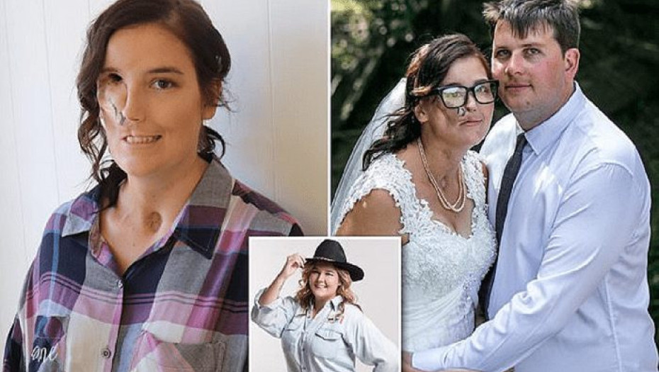 Ο καρκίνος της πήρε το μισό πρόσωπο αλλά εκείνη παντρεύτηκε τον αγαπημένο της έστω κι αν της απομένει 1 χρόνος ζωής