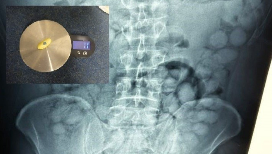 Συνελήφθη Βραζιλιάνος στο «Ελ. Βενιζέλος» για διακίνηση ναρκωτικών – Είχε καταπιεί 100 «αυγά» κοκαΐνης