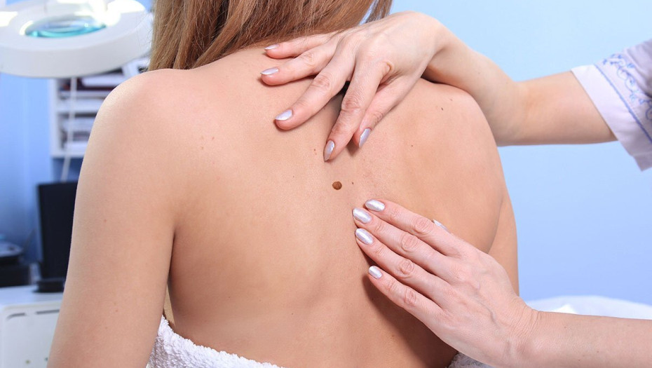 Καρκίνος του δέρματος: Τα 5 σημάδια στις ελιές που δεν πρέπει να αγνοήσετε – Πρόσεξέ το – σώζει ζωές