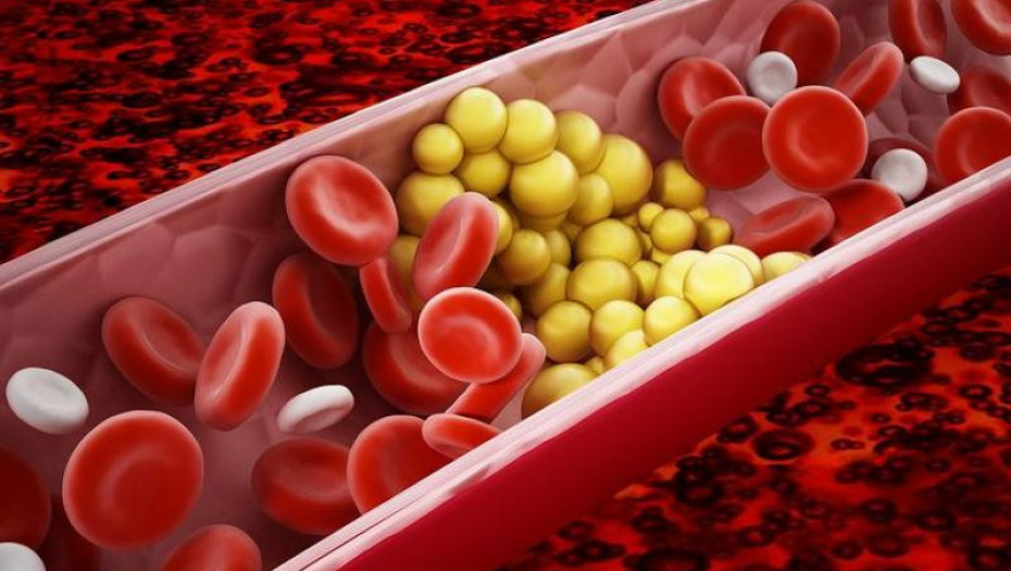 Το πρώτο βήμα για χαμηλότερη χοληστερίνη: Τι προτείνουν οι καρδιολόγοι