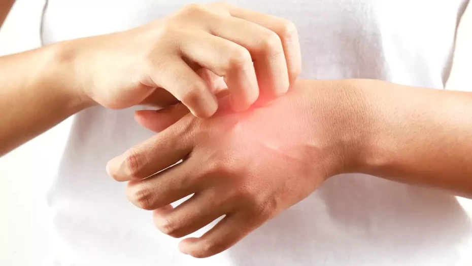 Τι είναι το αλλεργικό σοκ από το οποίο πέθανε ο 46χρονος στο Ναύπλιο: Πότε ένα τσίμπημα γίνεται απειλητικό για τη ζωή