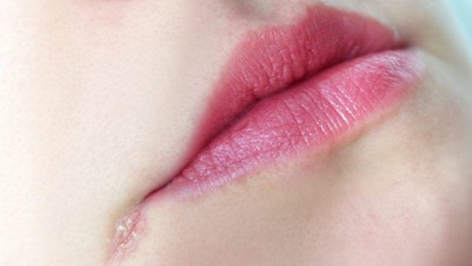 Τι να κάνετε για να μην σκάσουν τα χείλη σας από το τσουχτερό κρύο
