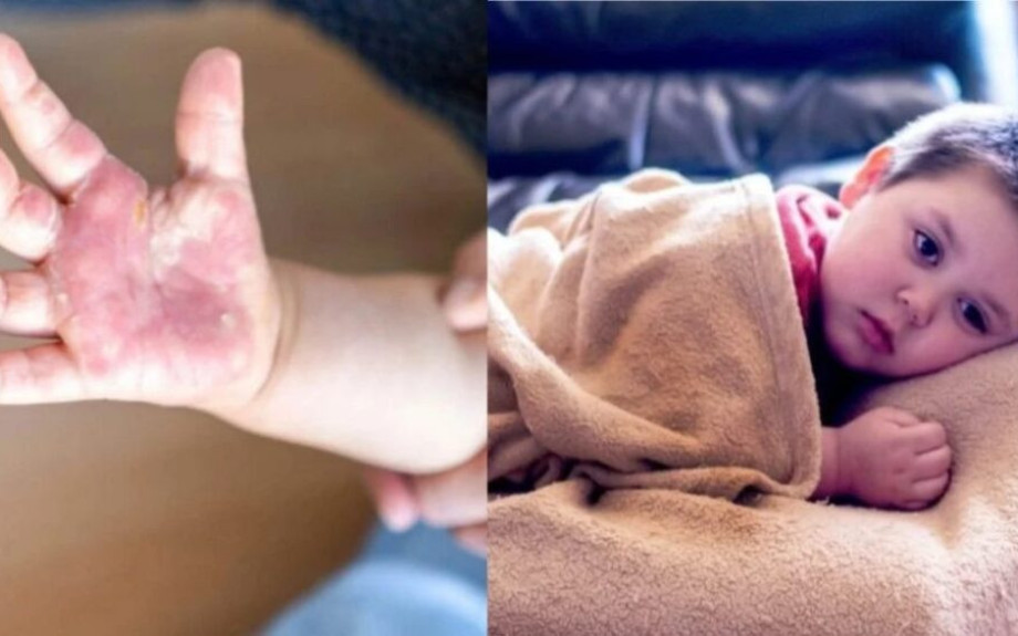 Γρίπη της ντομάτας: “Συναγερμός” για τον νέο μεταδοτικό ιό που απειλεί τα παιδιά – Τα ύπουλα συμπτώματα