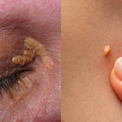 Σημάδια στο δέρμα: 10 “αθώα” συμπτώματα στην επιδερμίδα δείχνουν πως κάτι δεν πάει καλά με την υγεία μας