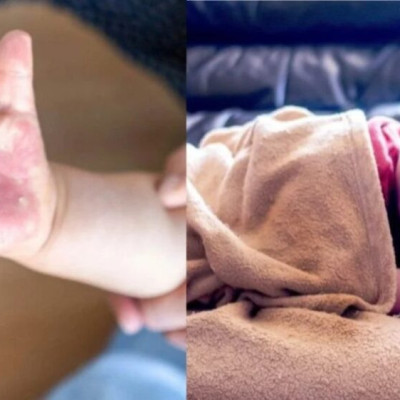 Γρίπη της ντομάτας: “Συναγερμός” για τον νέο μεταδοτικό ιό που απειλεί τα παιδιά – Τα ύπουλα συμπτώματα